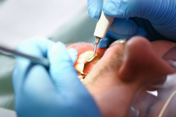 Best Emergency Dental Care for Broken or Chipped Teeth in Independence, KY